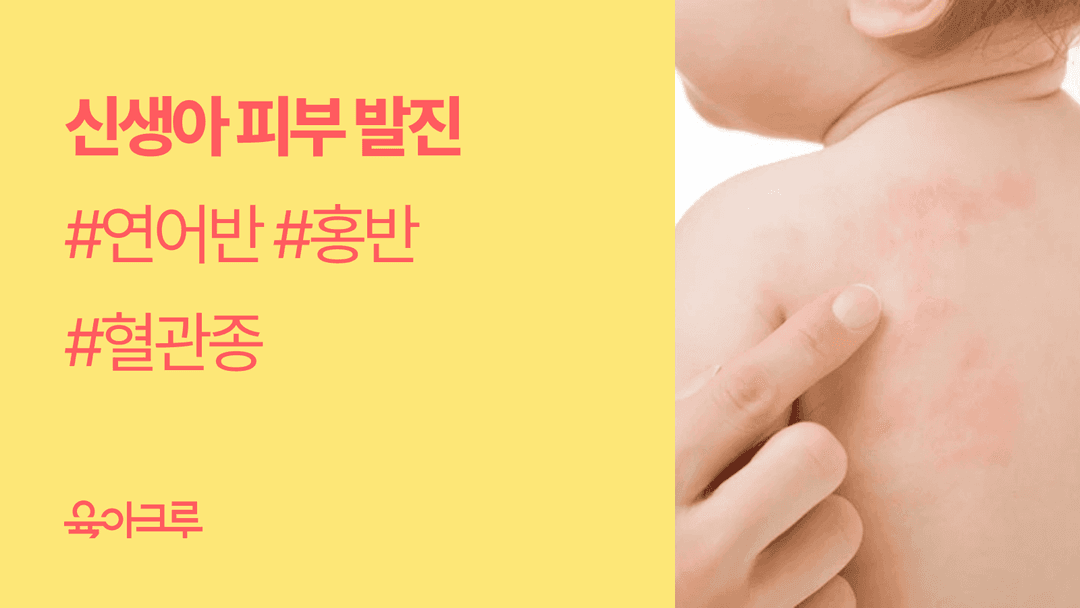 신생아 피부 발진, 연어반·홍반·혈관종 원인과 관리법 총정리