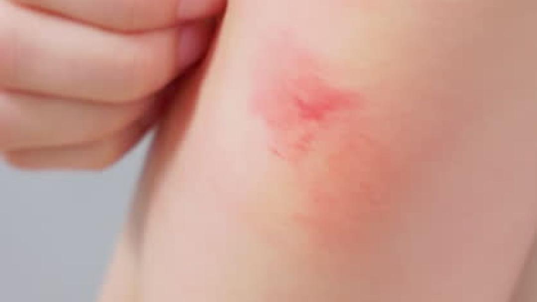 아기 피부 발진, 일교차가 원인일 수 있어요! 계절별 아기 피부 케어 팁